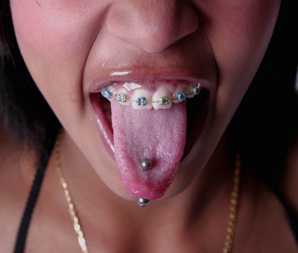 Appareil dentaire bleu et vert avec un piercing sur la langue
