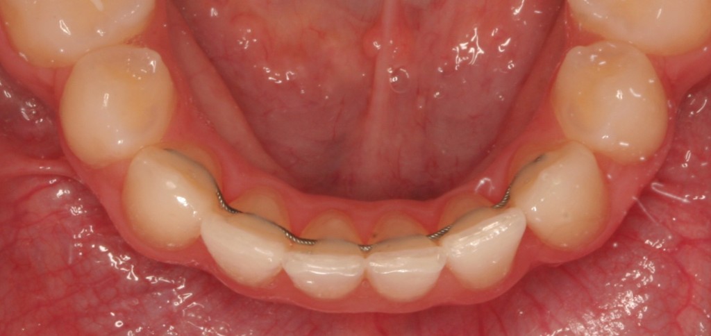 Appareil Dentaire Contention Linguale Fixe Permanente