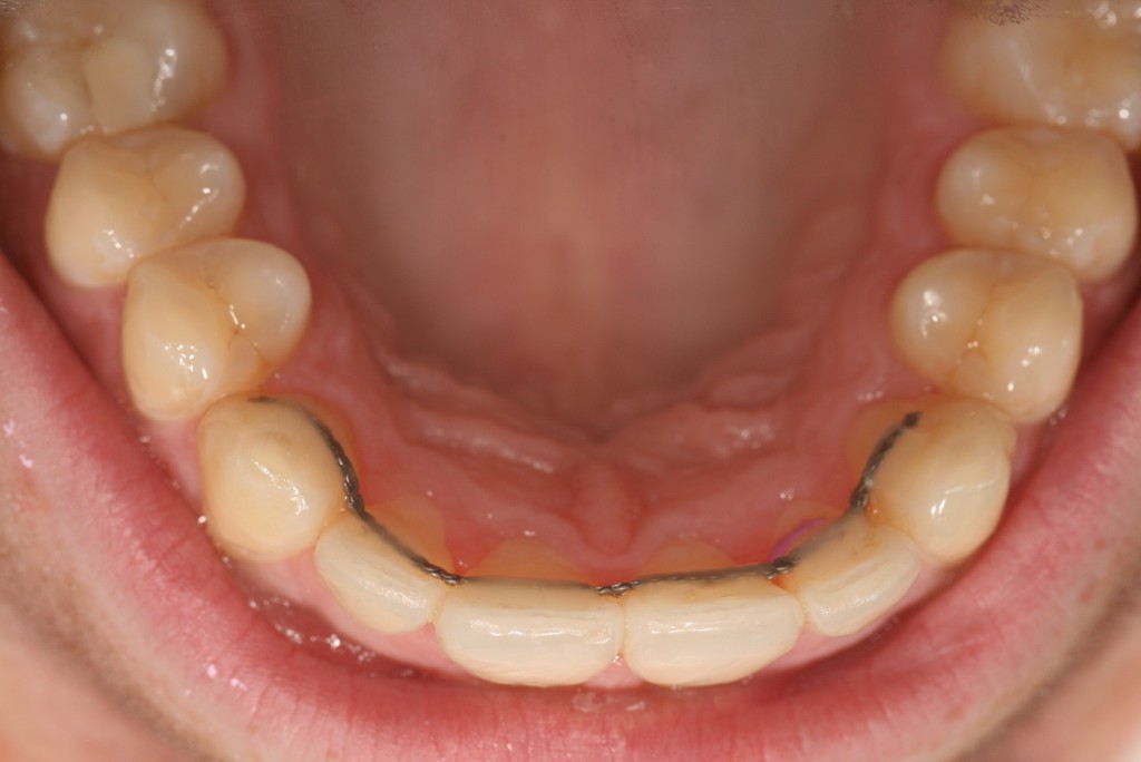 Contention Fixe Permanente Appareil Dentaire