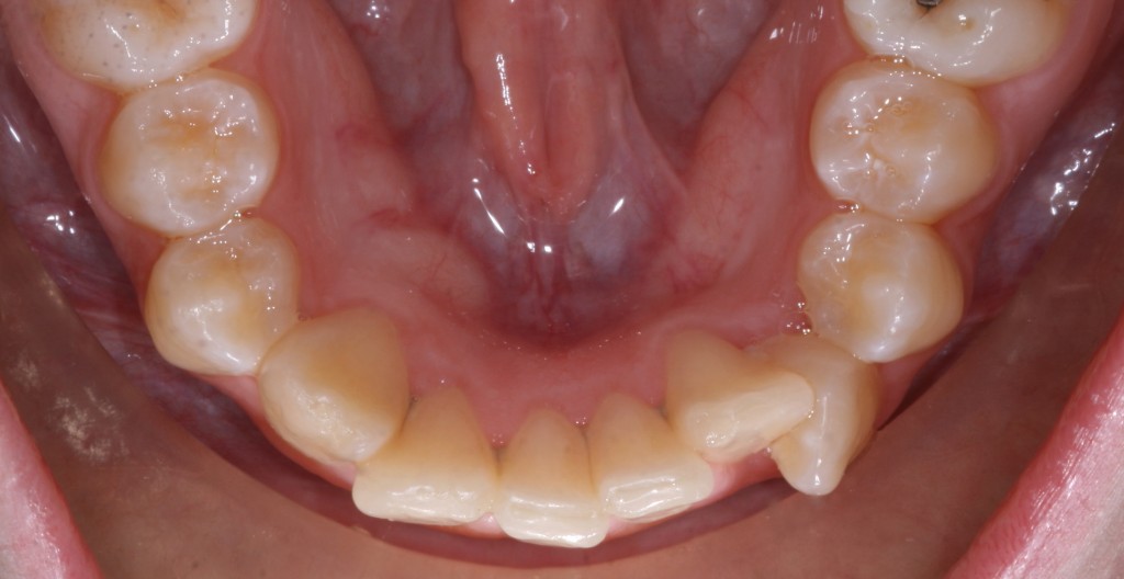 Dents mal alignées appareil dentaire adulte